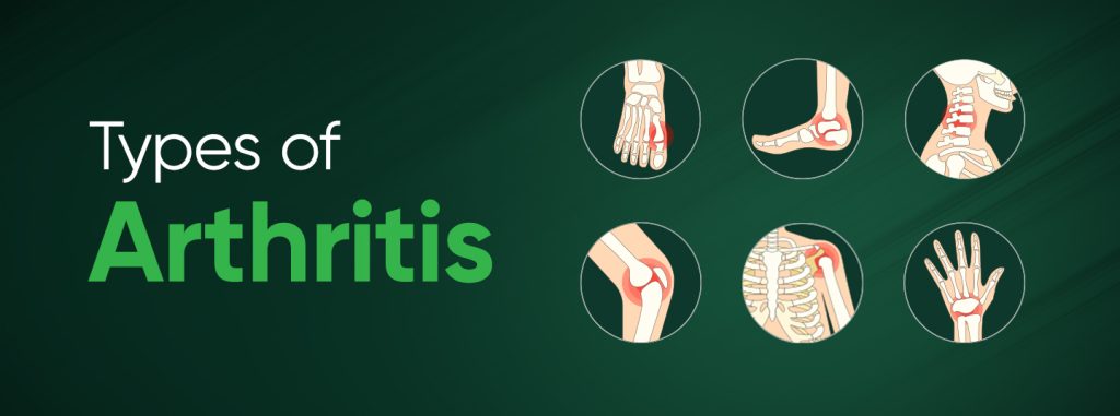 Arthritis Management: A Complete Guide to Relieving Joint Pain and Living Better